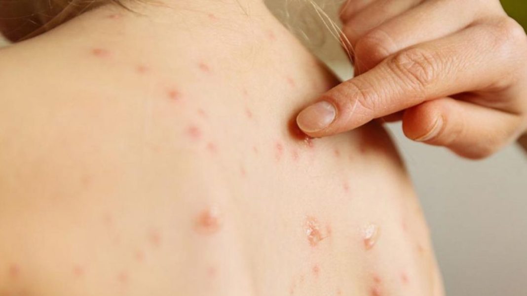 Investigan probables casos de sarampión en Lamarque Investigan probables casos de sarampión en Lamarque