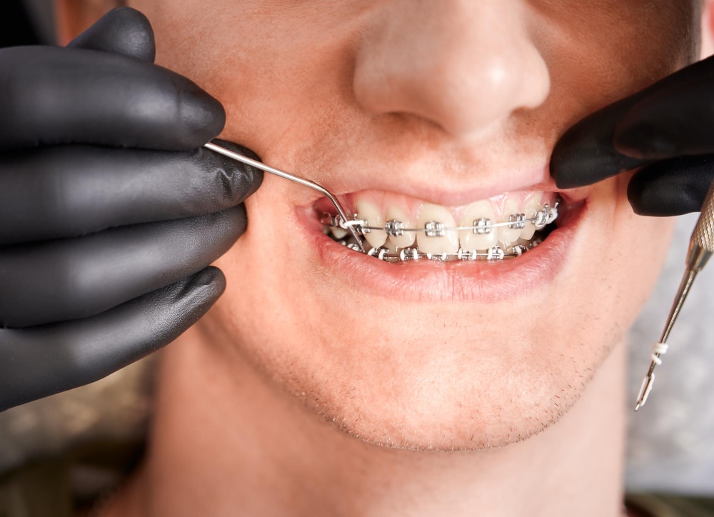 ANMAT advierte sobre brackets no registrados de la marca MERIT ANMAT advierte sobre brackets no registrados de la marca MERIT